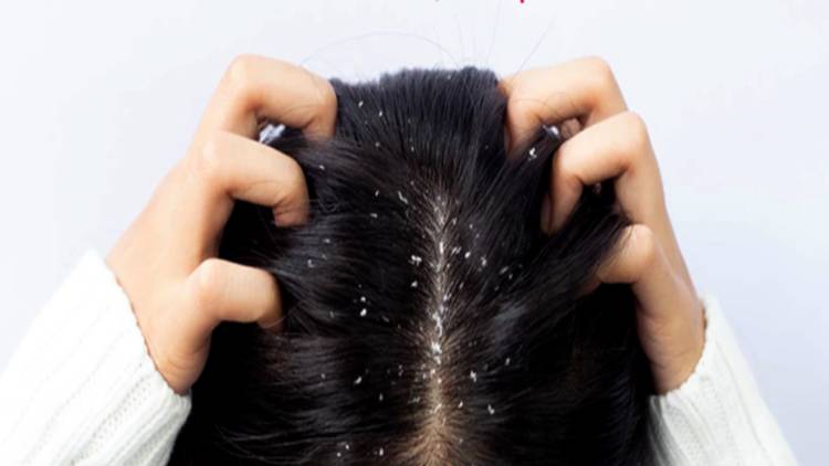 খুশকি দূর করার ৬ কার্যকর উপায়